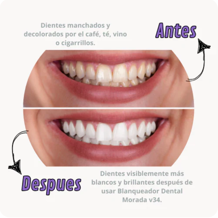 Dientes Blancos al Instante - GumiDent V34
